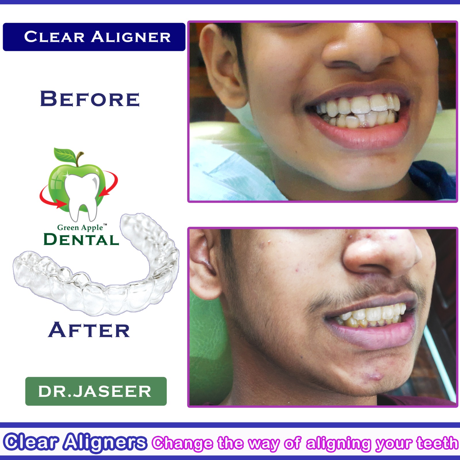 Platinum Plus Crowns — before and after by Dr. Jaseer R.P.