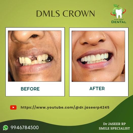 DMLS Crown — before and after by Dr. Jaseer R.P.