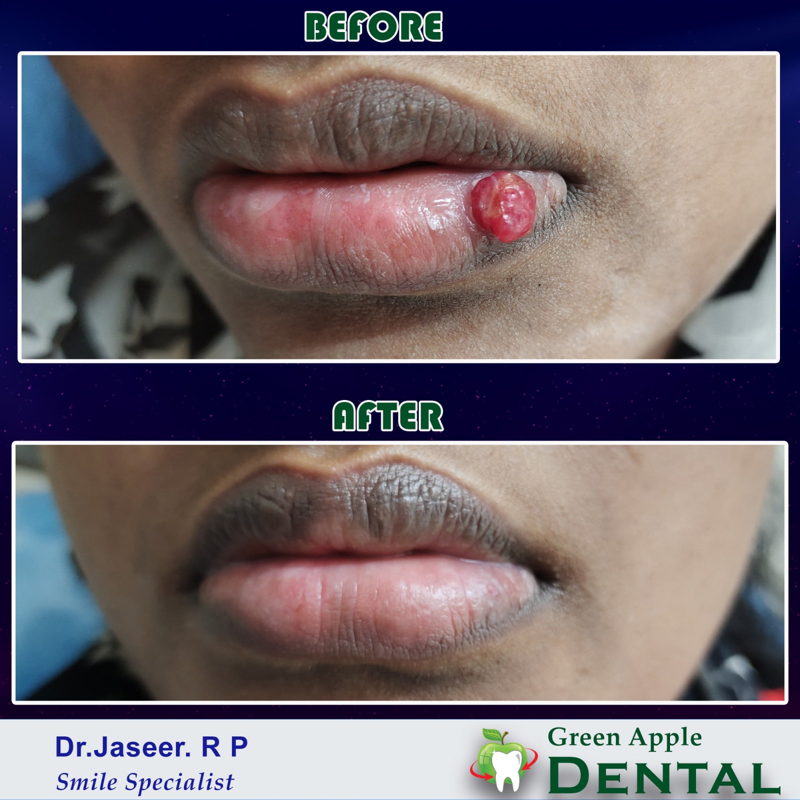 Oral Lesion Removal — before and after by Dr. Jaseer R.P.