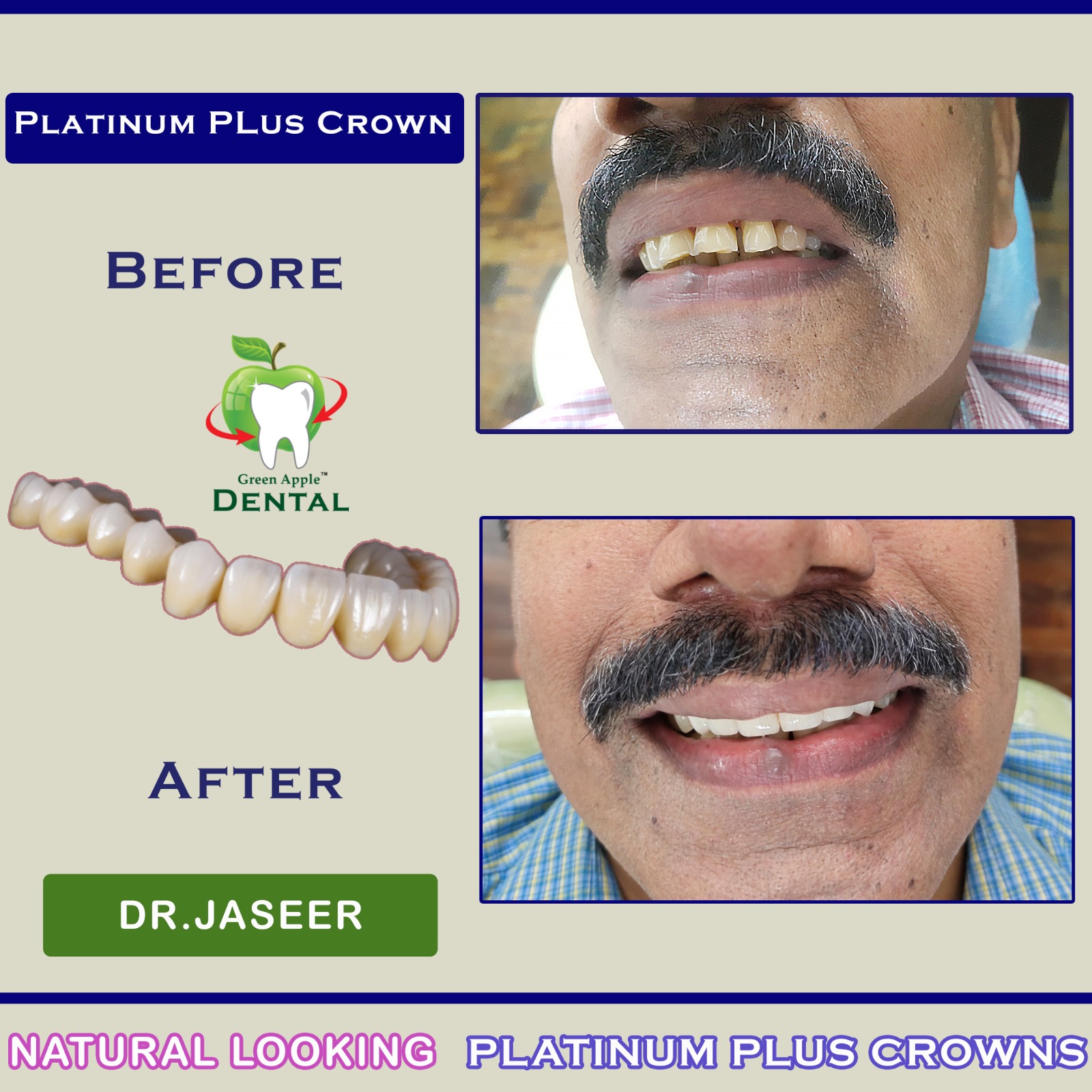 Platinum Plus Crown — before and after by Dr. Jaseer R.P.