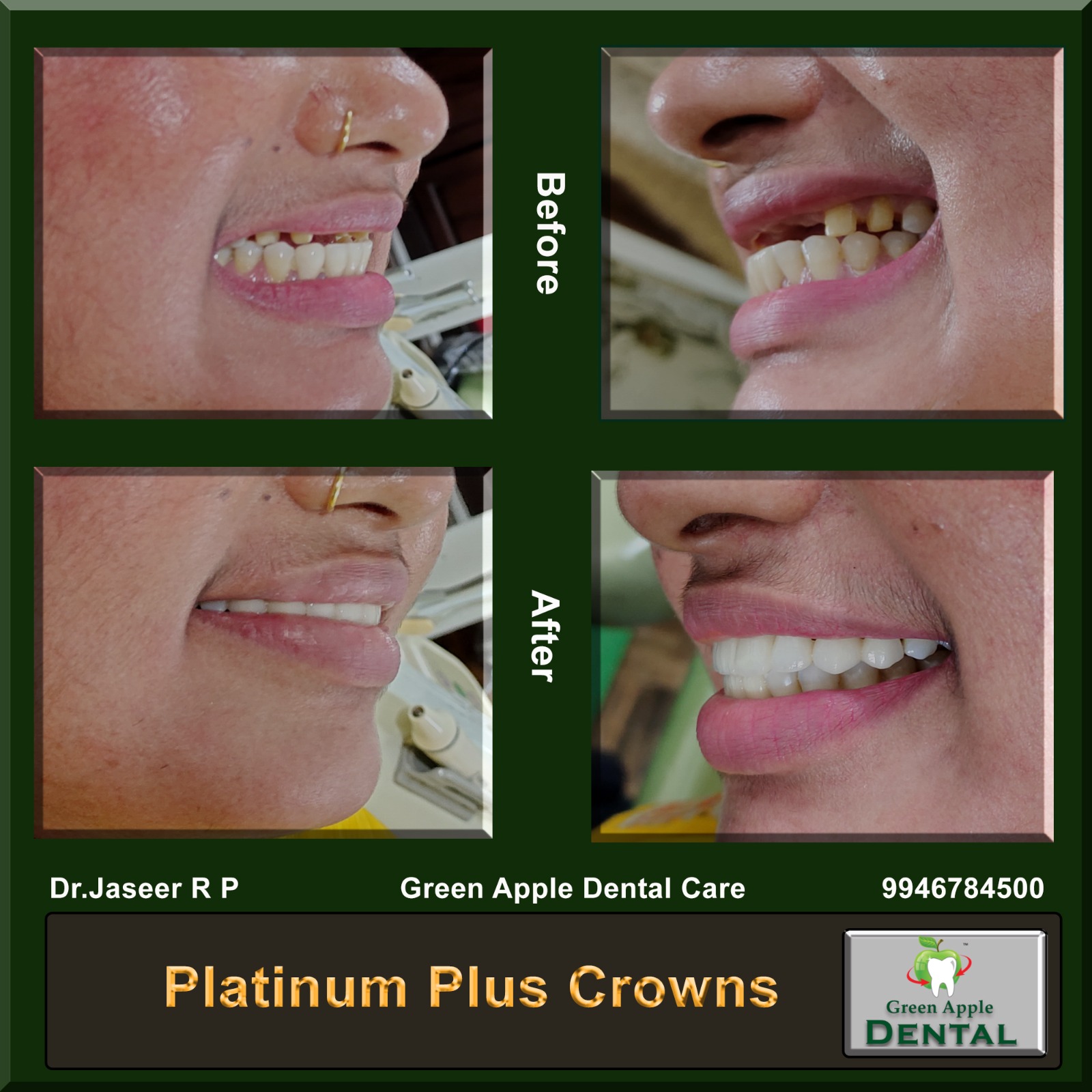 Clear Aligners — before and after by Dr. Jaseer R.P.