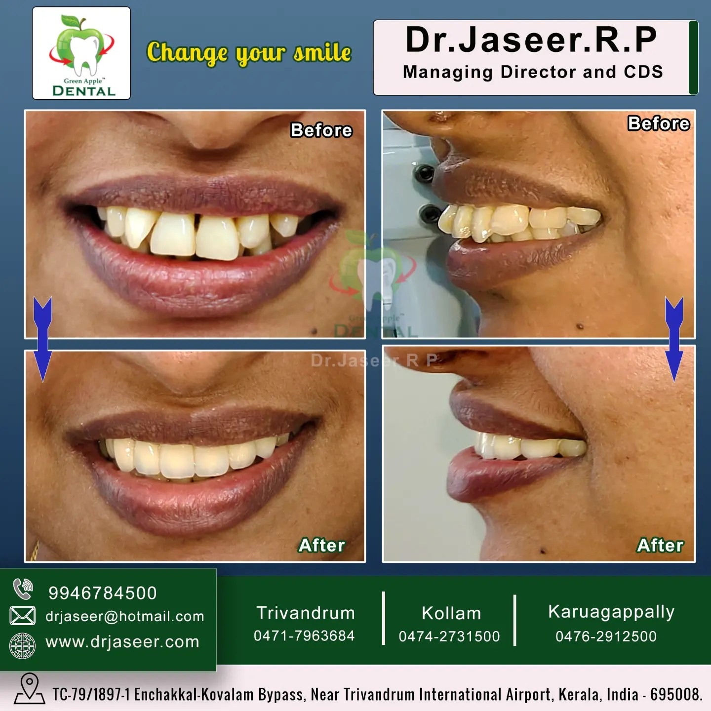 Smile Makeover — before and after by Dr. Jaseer R.P.